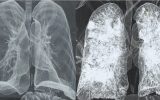 تصویری ترسناک از ریه یک کرونایی